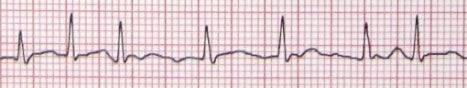 Atrial Fibrillation shown on ECG